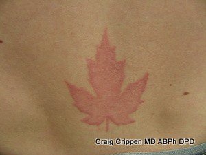 Laser Tattoo Removal in Kelowna from Dr. Crippen at DermMedica Clinic