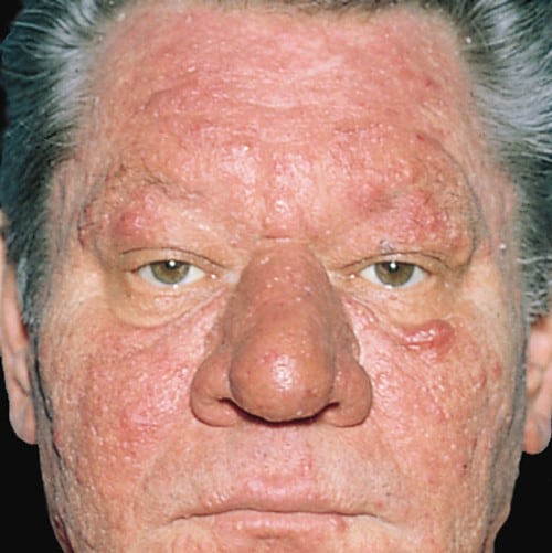 Rosacea in Adults: Condition, Treatments, and Pictures ...