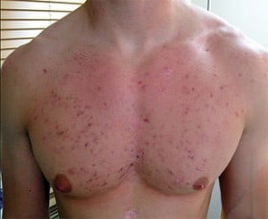 Steroid use acne treatment