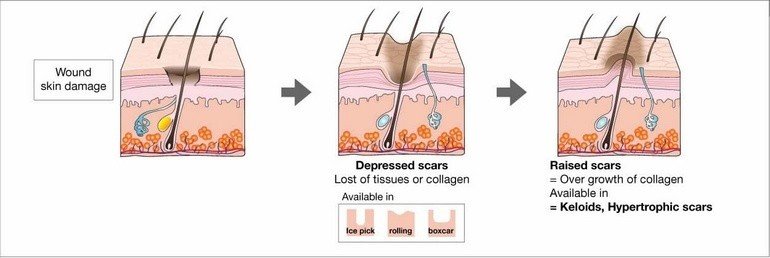 Removal Of Acne Scars In Kelowna - DermMedica
