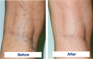 We Eliminate Unsightly Varicose And Spider Veins at 