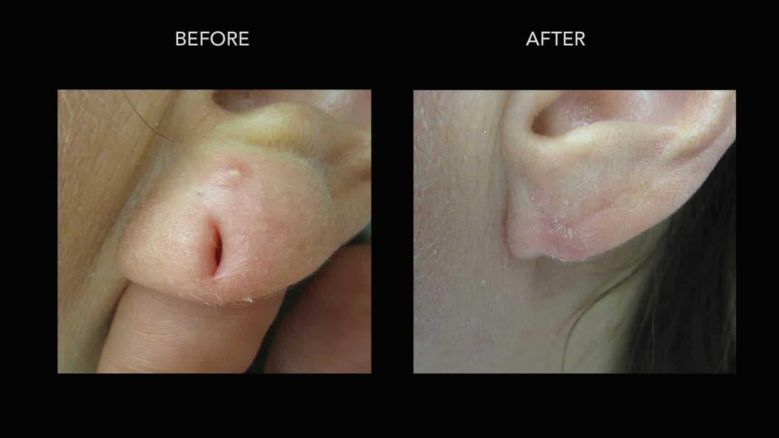Ear Lobe Repair Before and After Photos DermMedica