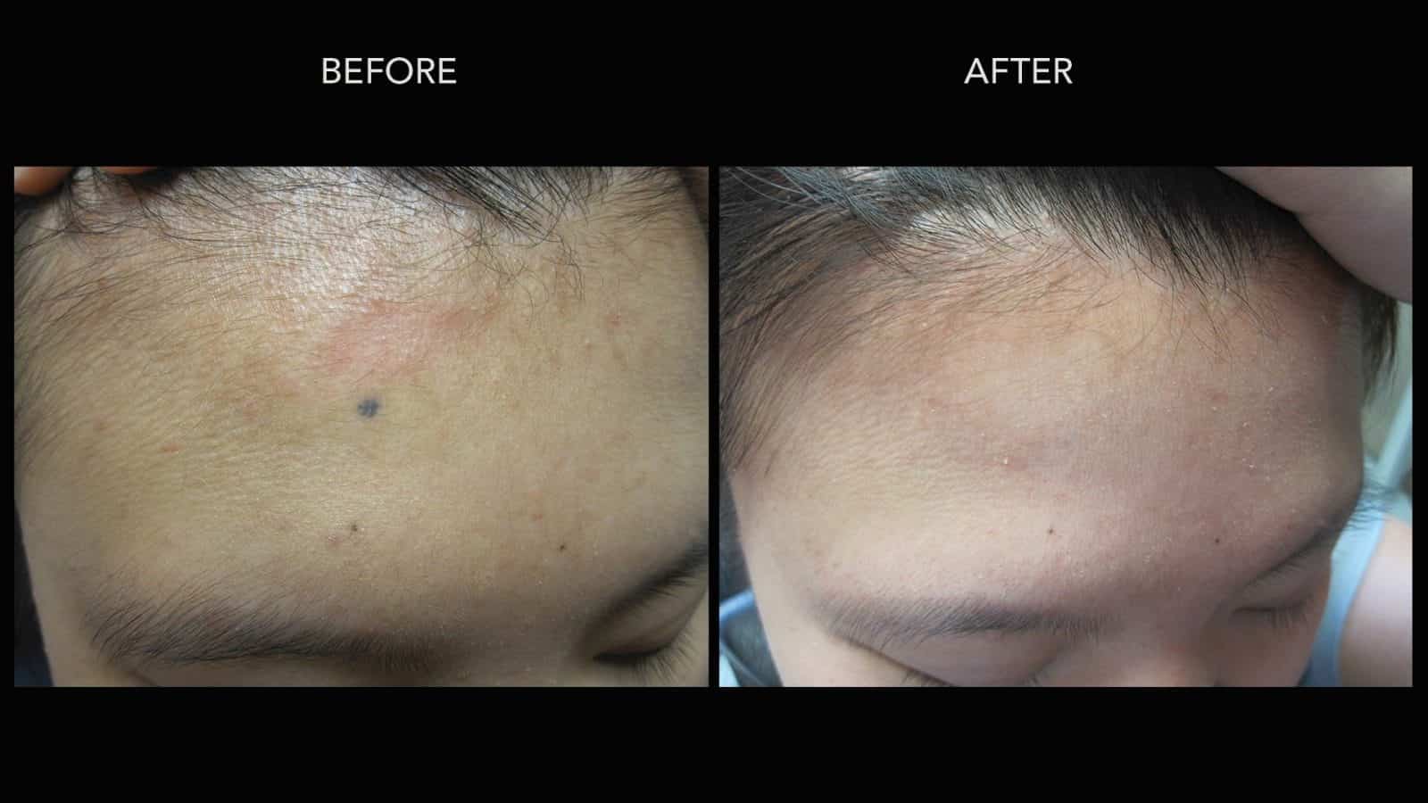 Facial Mole Removal Scars 31