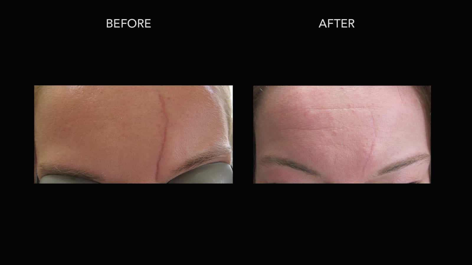 Scar Treatments Before and After Photos | DermMedica