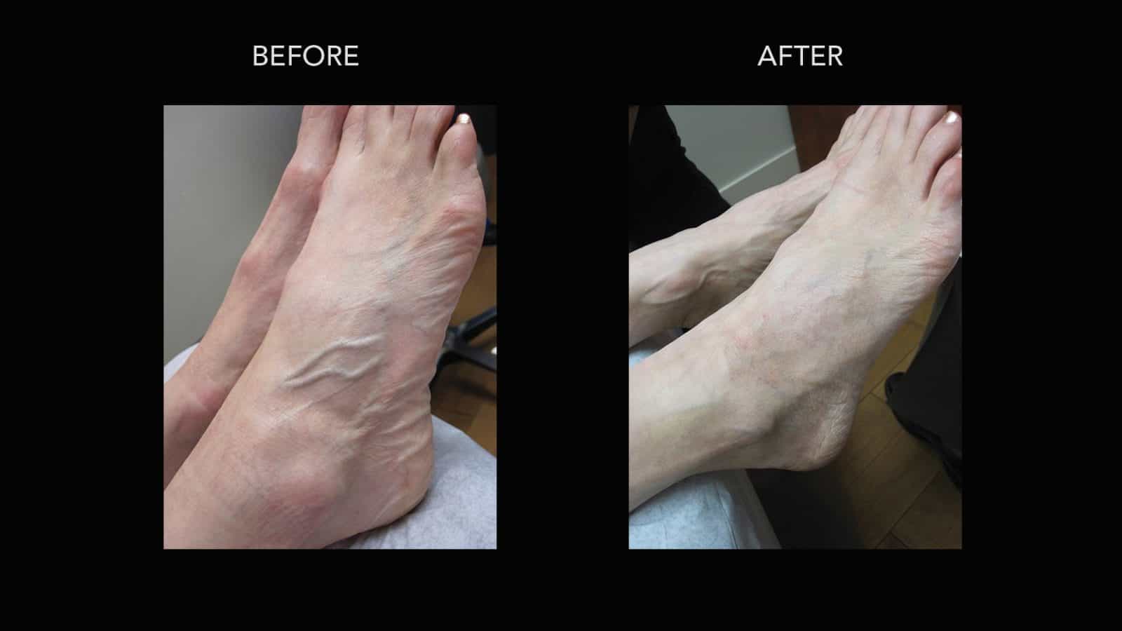 Vein Treatments Before and After Photos | DermMedica