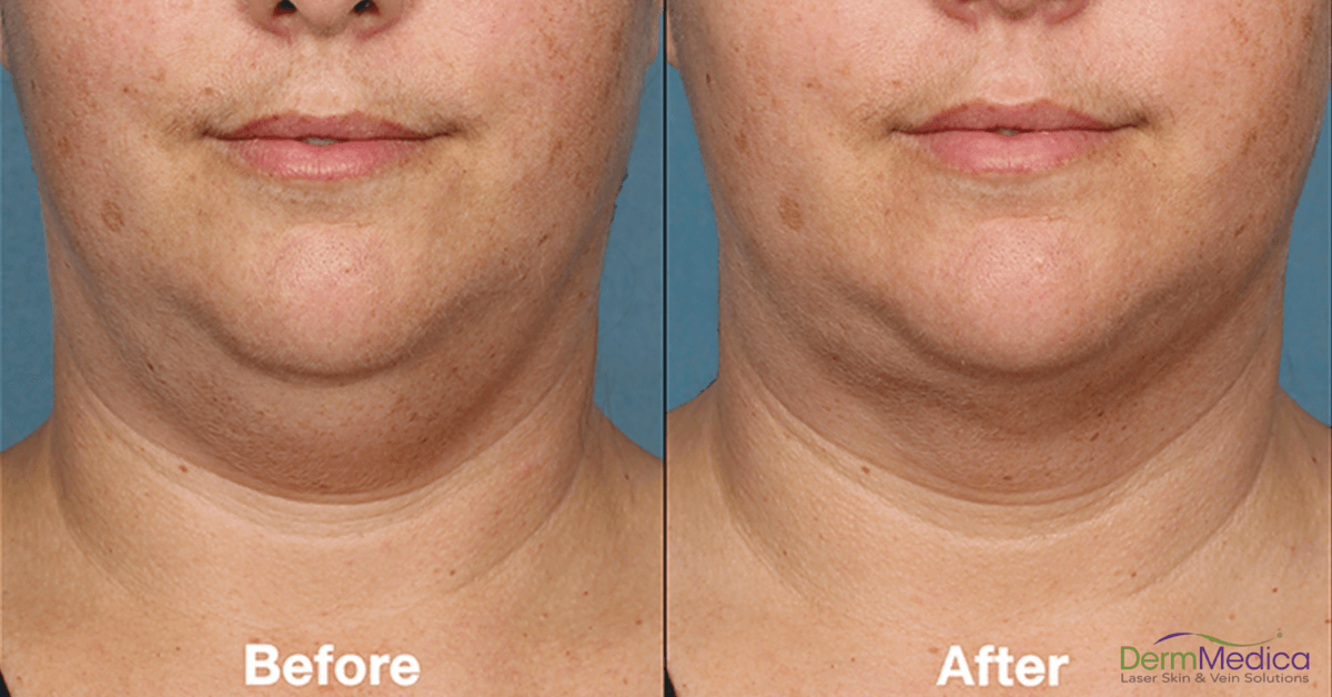 Belkyra in Kelowna - The Injectable Treatment for Double Chins