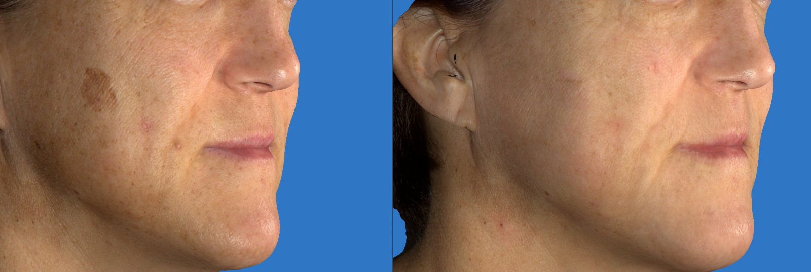Before &amp; After Gallery - DermMedica