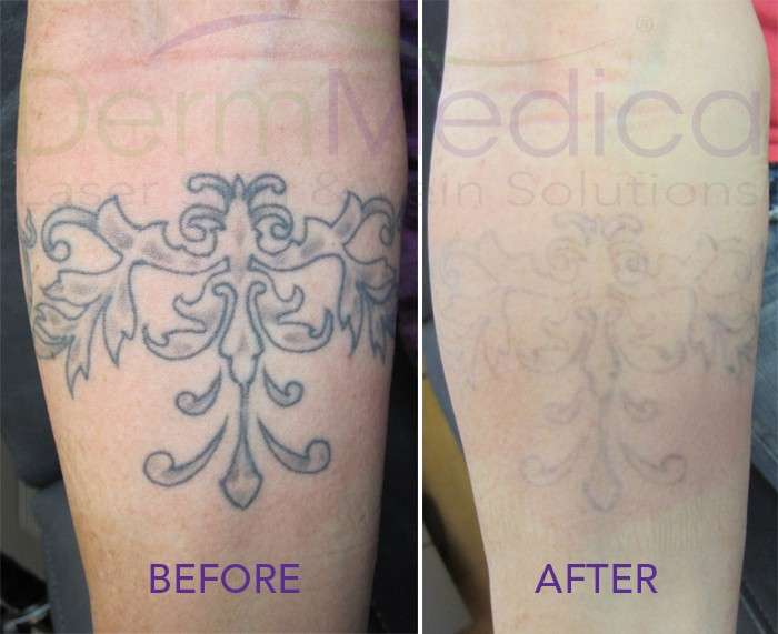 Looking to Cover Up an Old Tattoo with an New One? Laser Tattoo Removal Can  Help - DermMedica
