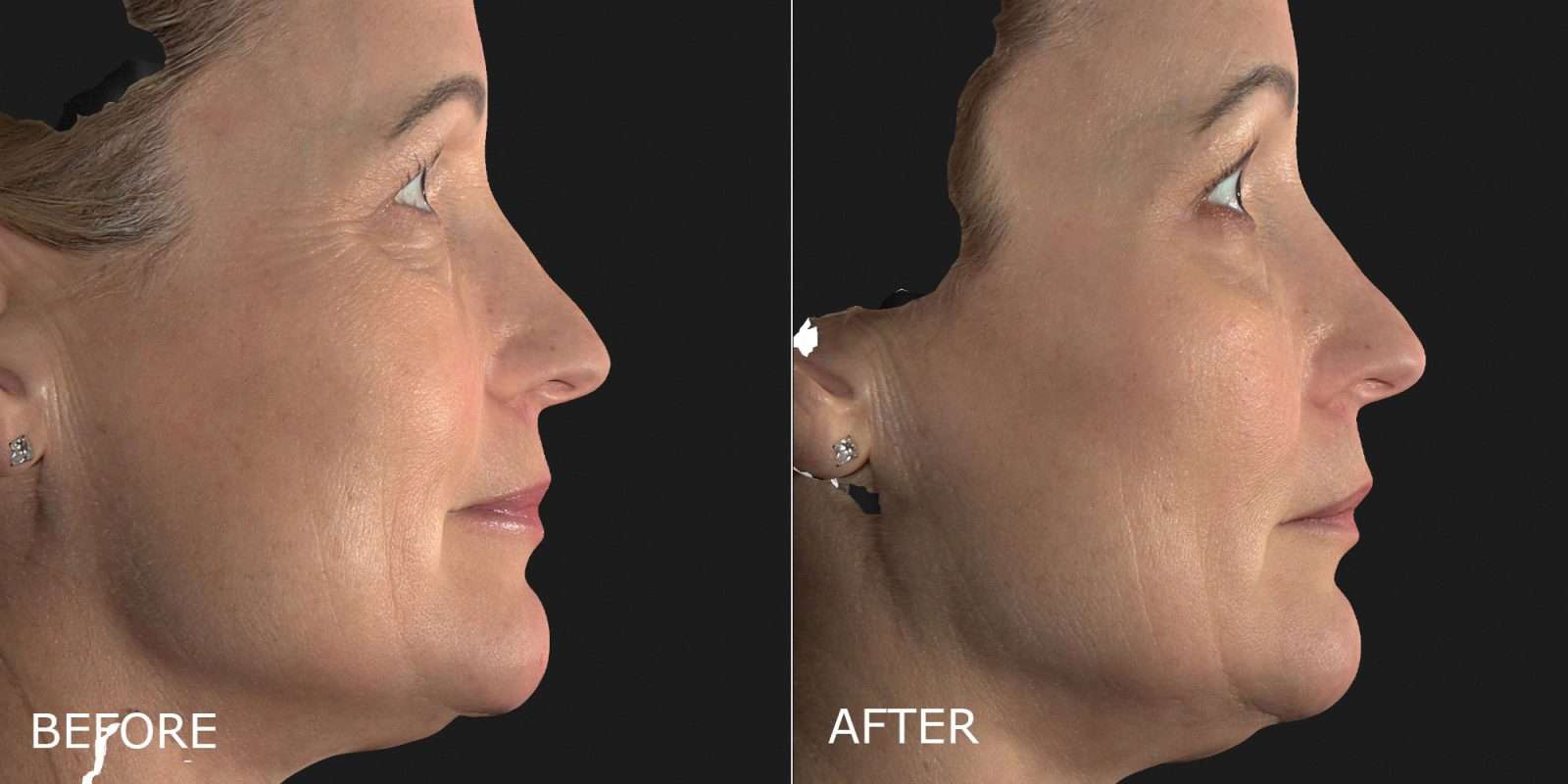 Botox Cosmetic Before and After Photo by Dr. Crippen in Kelowna, BC