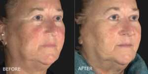 Thumbnail of http://Laser%20for%20Redness%20Before%20and%20After%20Photo%20by%20Dr.%20Crippen%20in%20Kelowna,%20BC