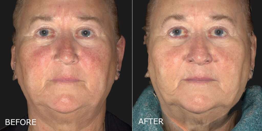 Laser for Redness Before and After Photo by Dr. Crippen in Kelowna, BC