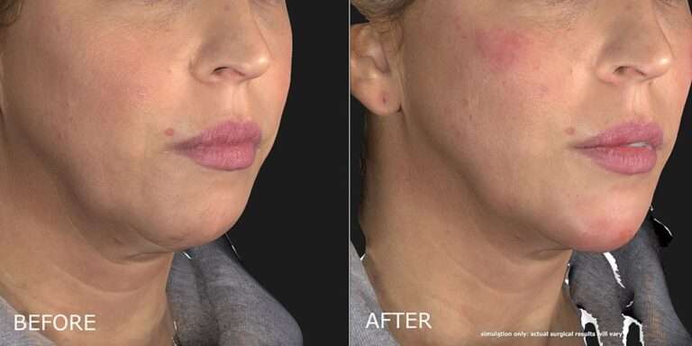 Thumbnail of http://Filler%20–%20Chin%20Before%20and%20After%20Photo%20by%20Dr.%20Crippen%20in%20Kelowna,%20BC