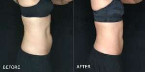 Thumbnail of http://CoolSculpting%20Before%20and%20After%20Photo%20by%20Dr.%20Crippen%20in%20Kelowna,%20BC