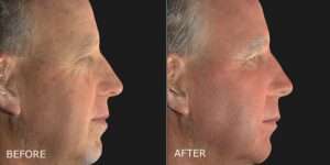 Thumbnail of http://DermaPeel%20–%20Laser%20Skin%20Resurfacing%20Before%20and%20After%20Photo%20by%20Dr.%20Crippen%20in%20Kelowna,%20BC