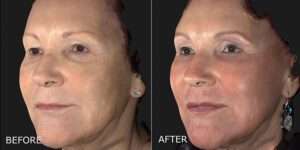 Thumbnail of http://DermaPeel%20–%20Laser%20Skin%20Resurfacing%20Before%20and%20After%20Photo%20by%20Dr.%20Crippen%20in%20Kelowna,%20BC