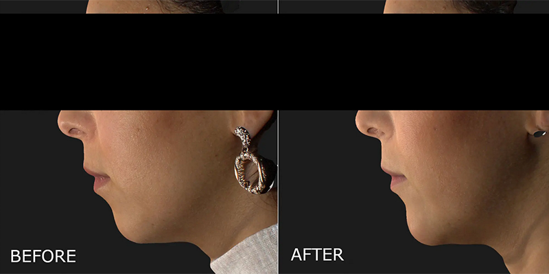 Filler – Chin Before and After Photo by Dr. Crippen in Kelowna, BC