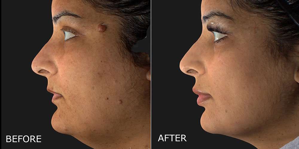 Filler – Lips Before and After Photo by Dr. Crippen in Kelowna, BC