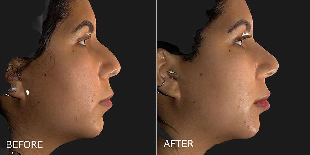 Filler – Lips Before and After Photo by Dr. Crippen in Kelowna, BC