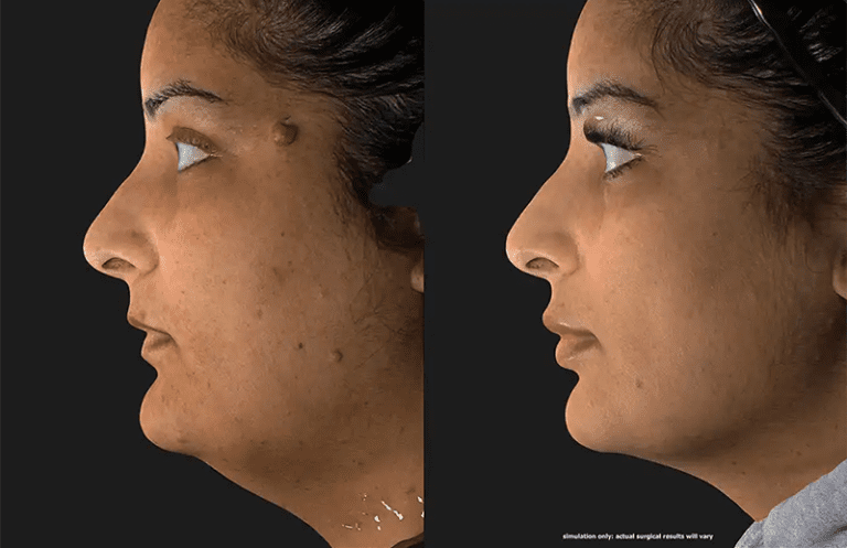 Mole Removal Before and After Photo by Dr. Crippen in Kelowna, BC