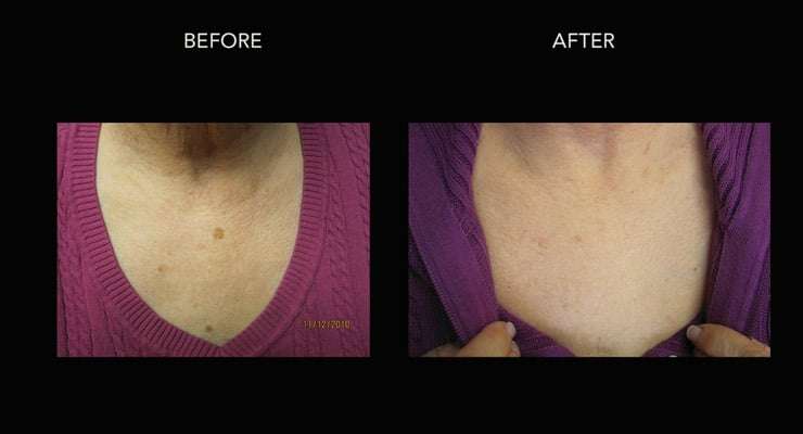 Brown Spot Removal Treatments Before and After Photo by Dr. Crippen in Kelowna, BC
