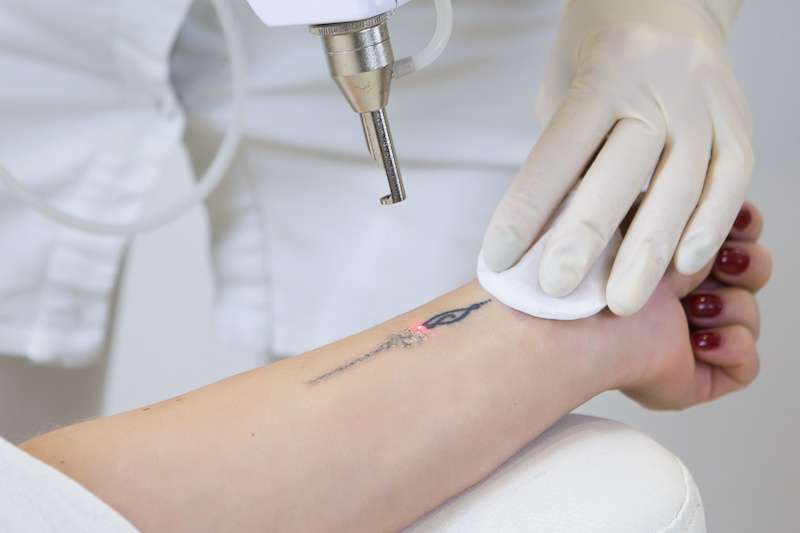 woman receiving laser tattoo removal treatment