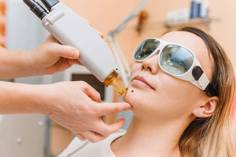 young woman receiving laser mole removal treatment