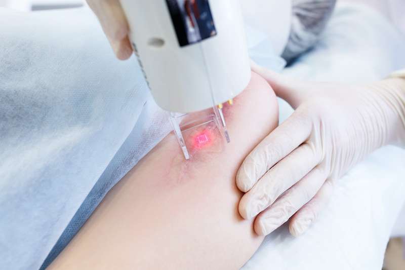 patient receiving scar removal laser treatment