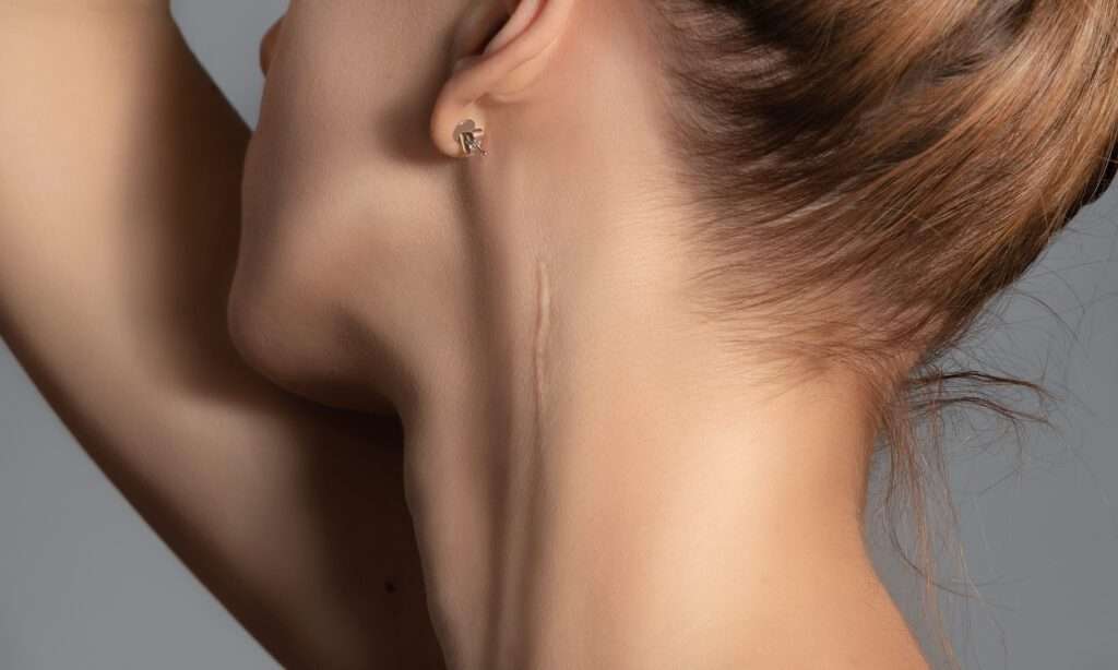 close-up image of young woman's neck with scar