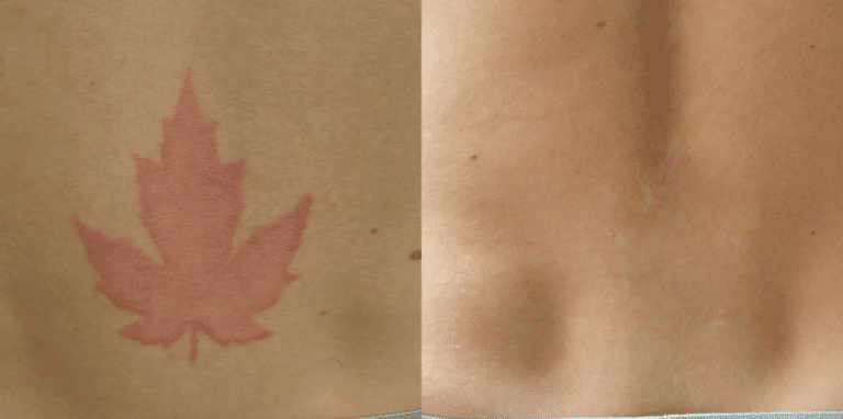 tattoo-removal-bxa1
